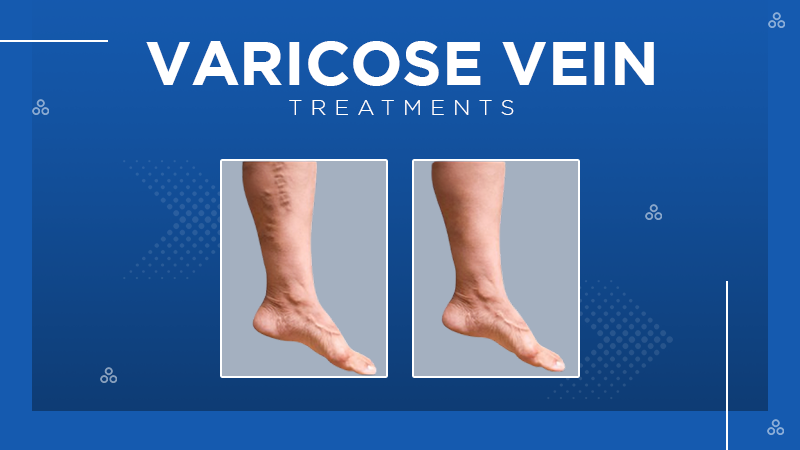 Varicose Vein Treatments